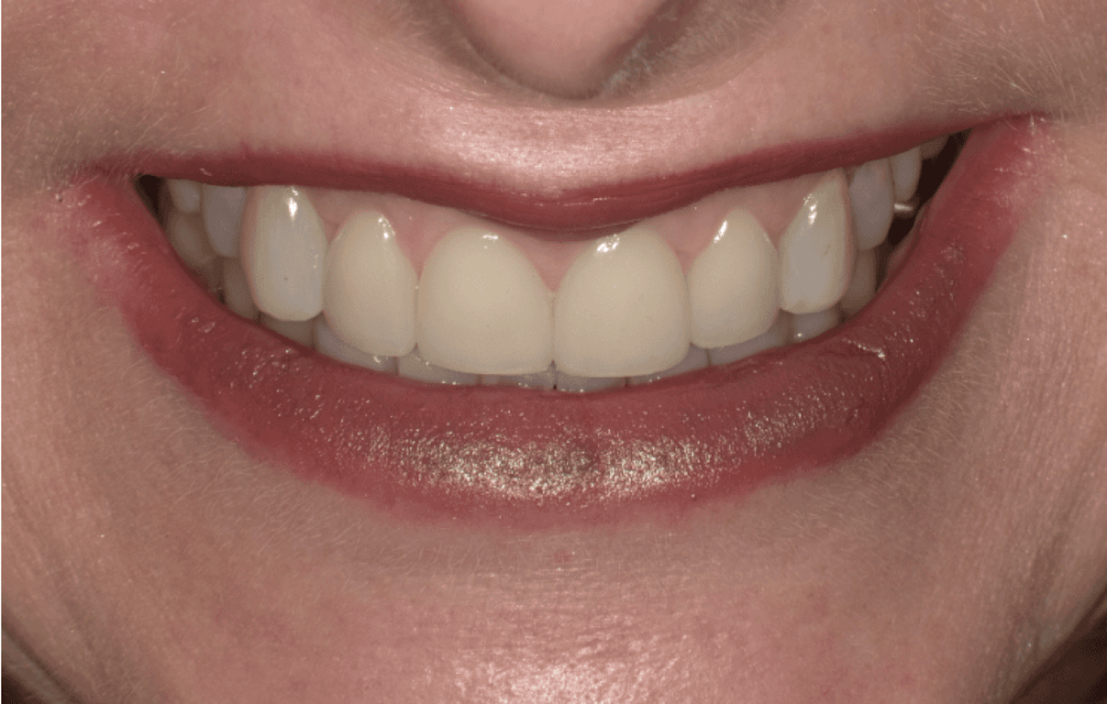 dental crowns before and after harrisonburg | dental crowns harrisonburg