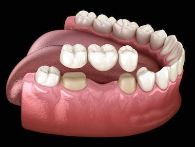 Dental Bridges in Harrisonburg, VA