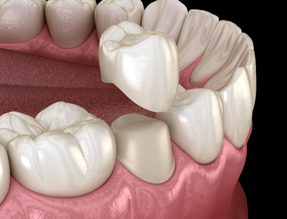 close up of dental crown on tooth | dental crowns harrisonburg va