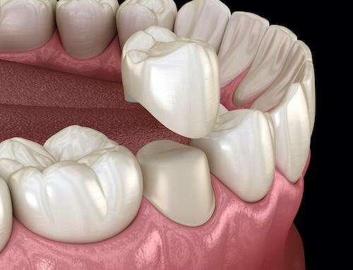 Dental Crowns Treatment in Harrisonburg, VA