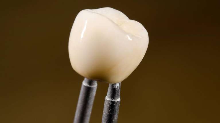 close up of dental crown | dental crowns before and after