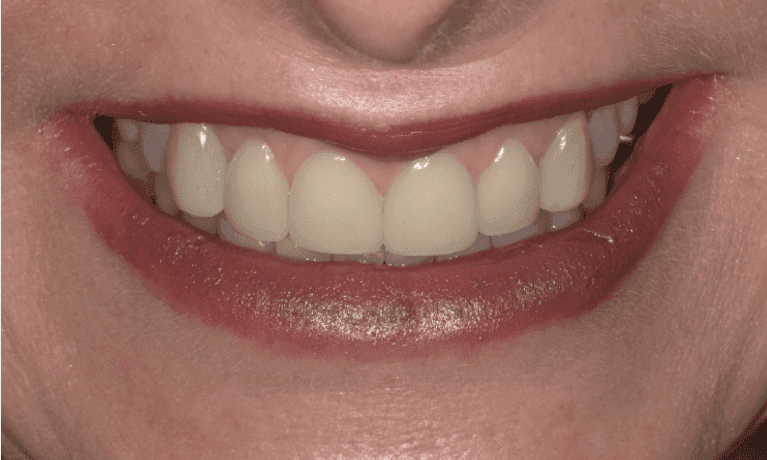 Anterior-Dental-Crowns-After-Image