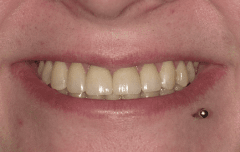 Front-Tooth-Crowns-After-Image