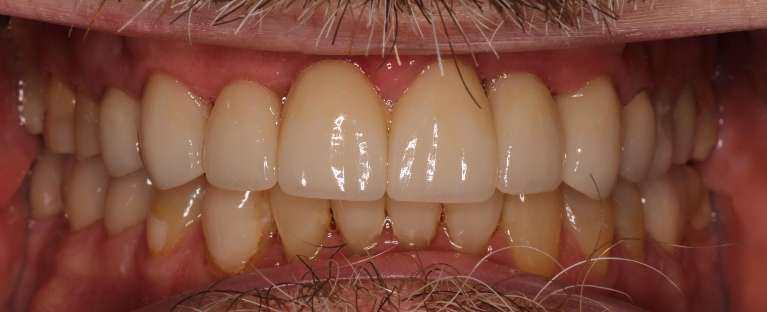 Cosmetic-Dentistry-After-Image