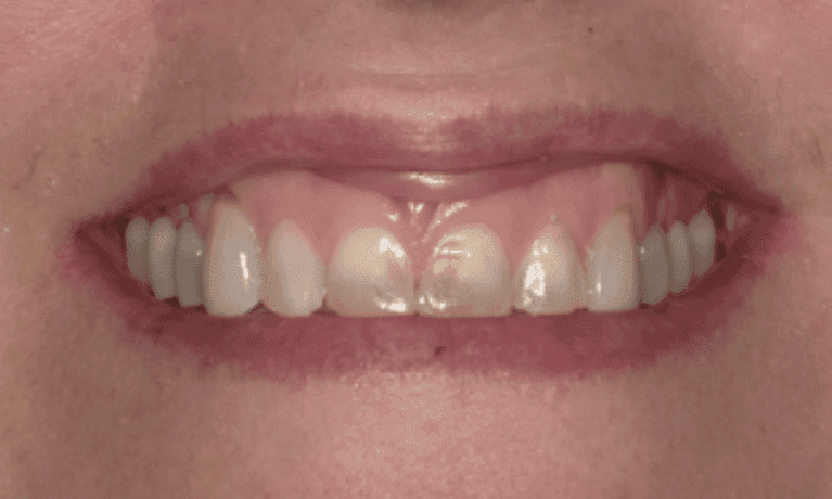 Anterior-Dental-Crowns-Before-Image