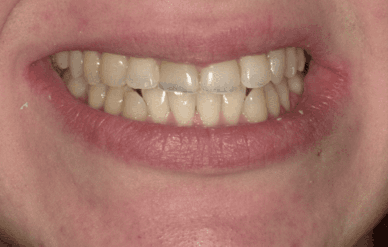 Front-Tooth-Crowns-Before-Image